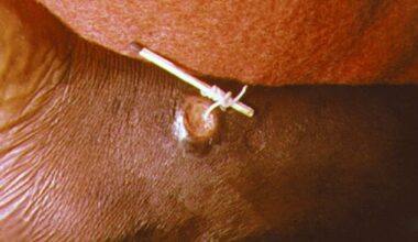 Zero Cases Of Guinea Worm Disease In 2024 So Far Sparks Hope Of Eradication