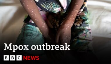 What is mpox and how is it spread? | BBC News