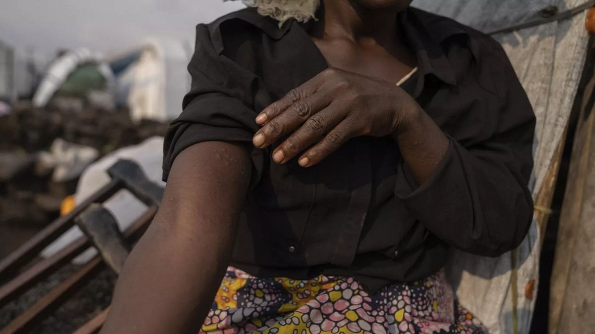 Mpox : l'UE exclut les contrôles aux frontières et le plan de vaccination commun