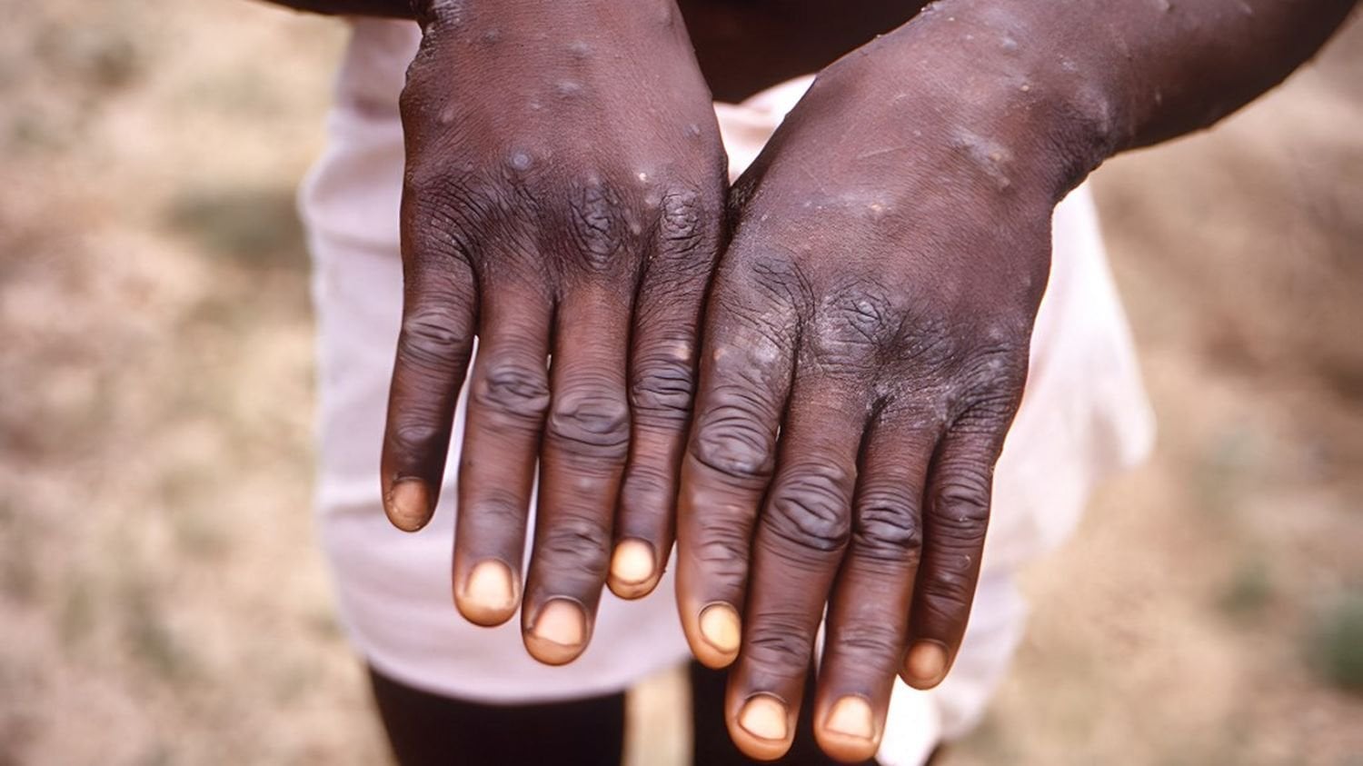 Variole du singe : l'agence de santé de l'Union africaine déclare "une urgence de santé publique"