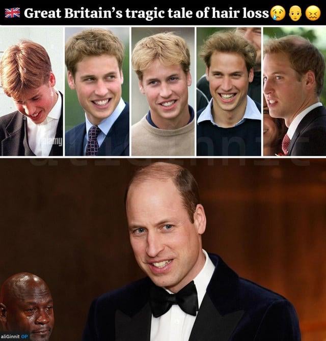 The royal family's hair loss saga: a cautionary tale for all.