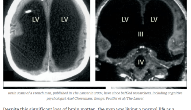 Frenchman with 90% of brain missing found to be operating indistinguishably from other French - quelle surprise! 🇫🇷