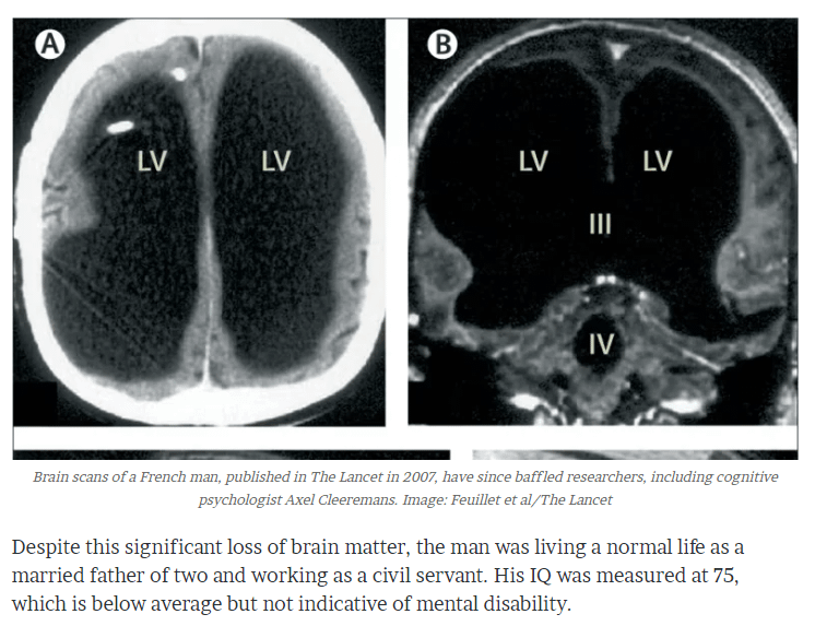 Frenchman with 90% of brain missing found to be operating indistinguishably from other French - quelle surprise! 🇫🇷