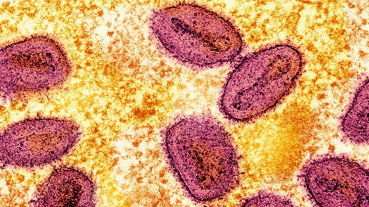 Mpox: Erster Nachweis von neuer Variante Ib in Deutschland