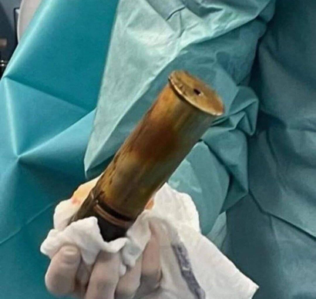 88 year old French man evacuated a whole hospital because he had a WW1 shell stuck in his anus